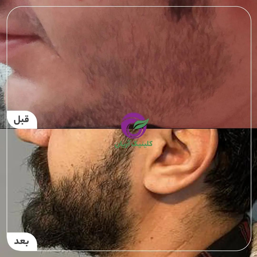 گالری کاشت ریش و سبیل